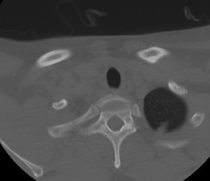 C7 laminar fracture and Klippel-Feil syndrome (Radiopaedia 86710-102850 Axial bone window 70).jpg