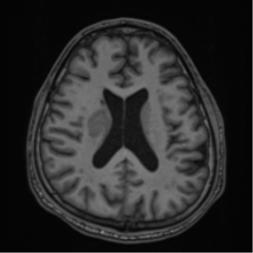CNS vasculitis (Radiopaedia 55715-62263 Axial T1 47).png