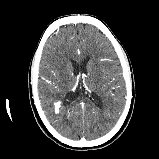 Calcified cerebral hydatid cyst (Radiopaedia 65603-74717 Axial with contrast 44).jpg