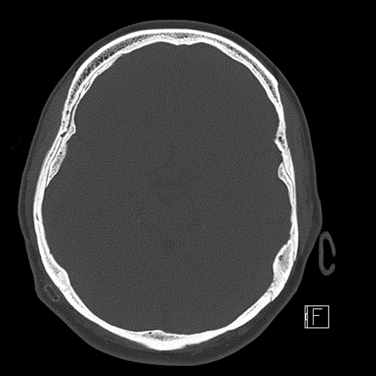 Calcified chronic subdural hematoma (Radiopaedia 77374-89492 Axial bone window 50).jpg