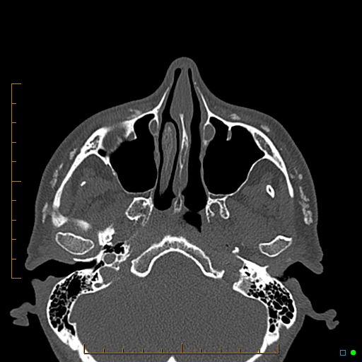 Calcified facial augmentation fillers (Radiopaedia 79514-92679 Axial bone window 20).jpg