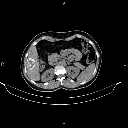 File:Calcified hepatic hydatid cyst (Radiopaedia 84672-100095 Axial non-contrast 34).jpg