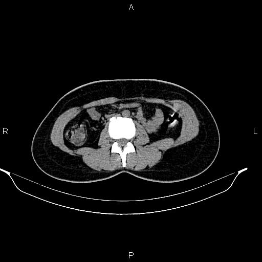 File:Calcified hepatic hydatid cyst (Radiopaedia 84672-100095 Axial non-contrast 60).jpg
