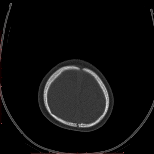Calcified middle cerebral artery embolism (Radiopaedia 78949-91860 Axial bone window 67).jpg