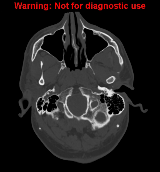 Calvarial thickening from chronic shunting (Radiopaedia 60079-67637 Axial bone window 15).jpg