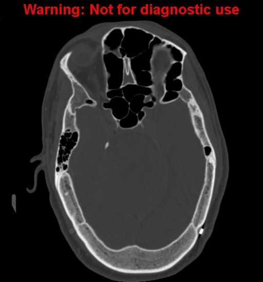 Calvarial thickening from chronic shunting (Radiopaedia 60079-67637 Axial bone window 64).jpg