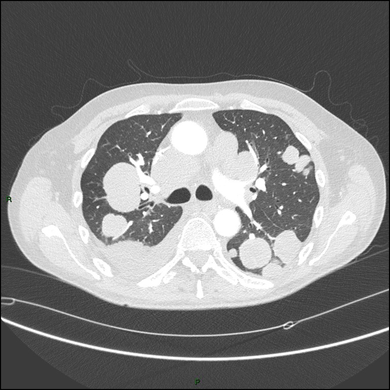 Cannonball metastases (Radiopaedia 82110-96150 Axial lung window 80).jpg