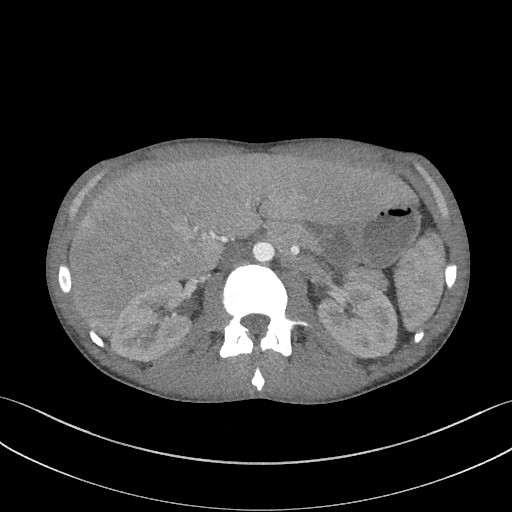 Cannonball metastases - testicular choriocarcinoma (Radiopaedia 84510-99891 B 119).jpg