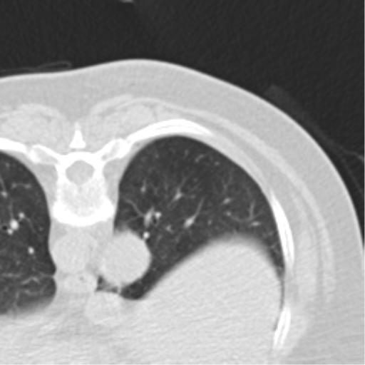 Carcinoid tumor - lung (Radiopaedia 44814-48644 Axial lung window 36).png