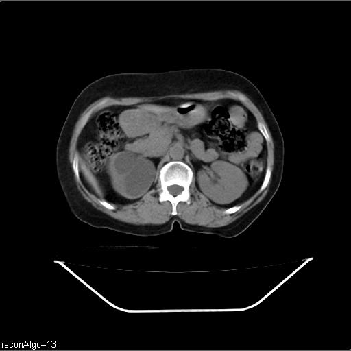 File:Carcinoma cervix- recurrence (Radiopaedia 34702-36137 Axial non-contrast 18).jpg