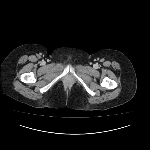 Carcinoma colon - hepatic flexure (Radiopaedia 19461-19493 A 137).jpg