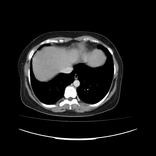 Carcinoma colon - hepatic flexure (Radiopaedia 19461-19493 A 15).jpg