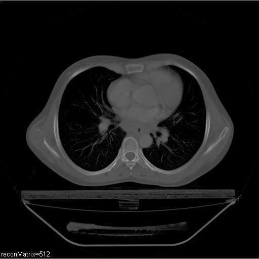 File:Carcinoma of esophagus (Radiopaedia 27356-27550 Axial bone window 17).jpg