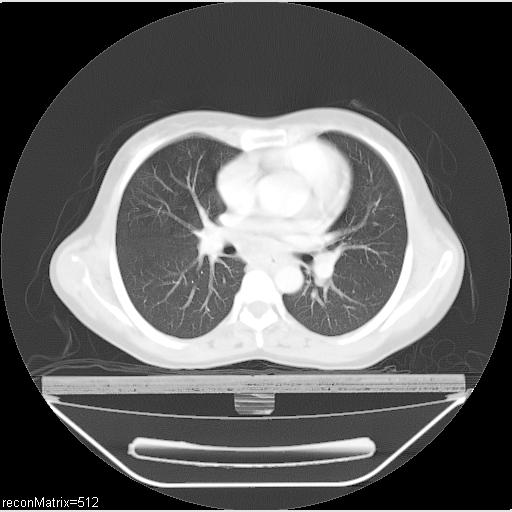 File:Carcinoma of esophagus (Radiopaedia 27356-27550 Axial lung window 18).jpg