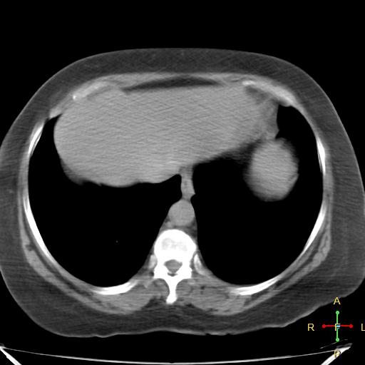 File:Carcinoma of sigmoid colon (Radiopaedia 23071-23100 C+ delayed 1).jpg