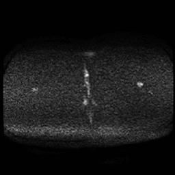 Carcinoma of the cervix (Radiopaedia 89018-105858 Axial DWI 41).jpg