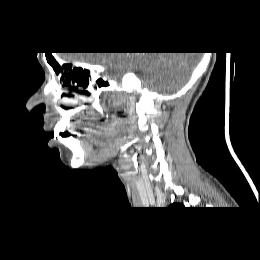 Carcinoma of the maxillary antrum (Radiopaedia 53805-59888 Sagittal C+ delayed 115).jpg