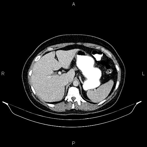 File:Carcinoma of uterine cervix (Radiopaedia 85861-101700 A 35).jpg