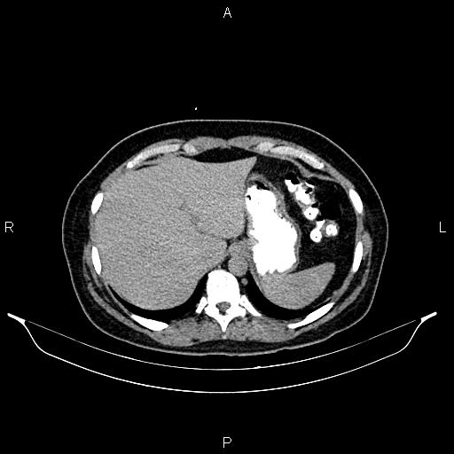 File:Carcinoma of uterine cervix (Radiopaedia 85861-101700 Axial C+ delayed 1).jpg