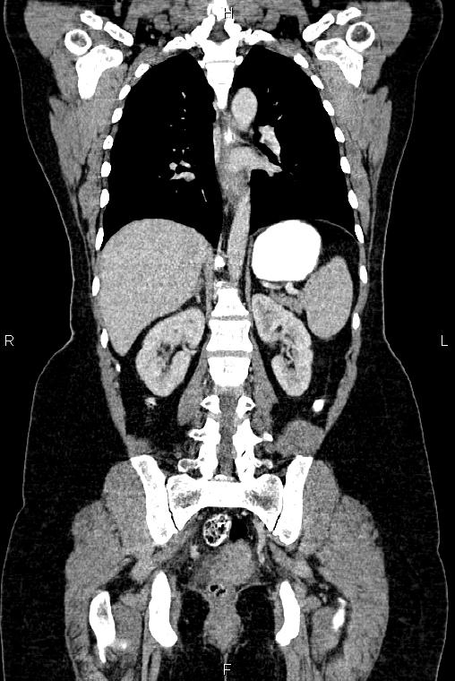 Carcinoma of uterine cervix (Radiopaedia 85861-101700 C 38).jpg
