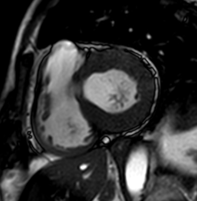 Cardiac amyloidosis - ATTR wild-type (Radiopaedia 74412-85296 short axis cine SSFP 128).jpg