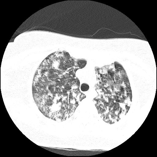 Cardiac angiosarcoma (Radiopaedia 66010-75181 Axial lung window 72).jpg