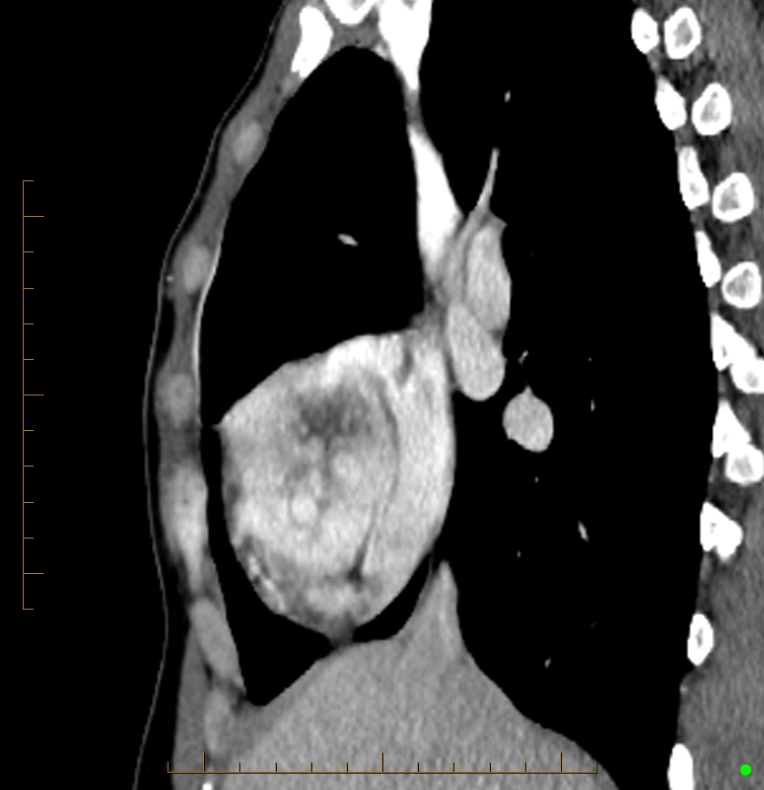 Cardiac paraganglioma (Radiopaedia 76345-88005 C 81).jpg