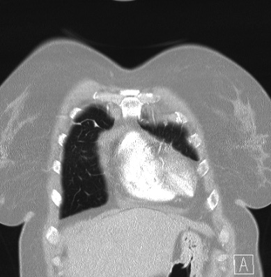 File:Cardiac sarcoidosis (Radiopaedia 74548-85534 Coronal lung window 7).jpg
