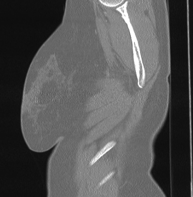 Cardiac sarcoidosis (Radiopaedia 74548-85534 Sagittal lung window 90).jpg