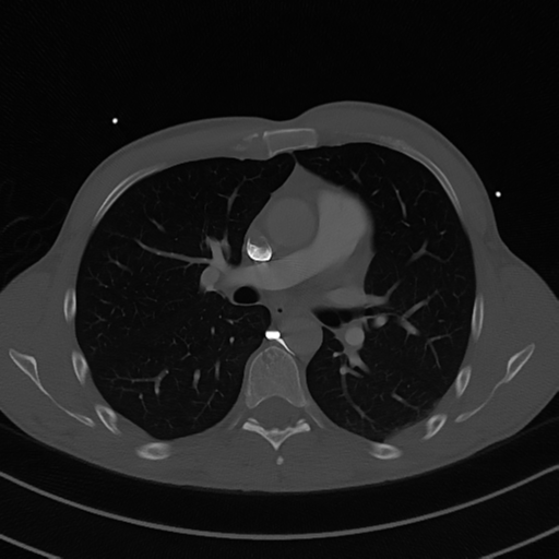 File:Cardiac tumor - undifferentiated pleomorphic sarcoma (Radiopaedia 45844-50134 Axial bone window 31).png
