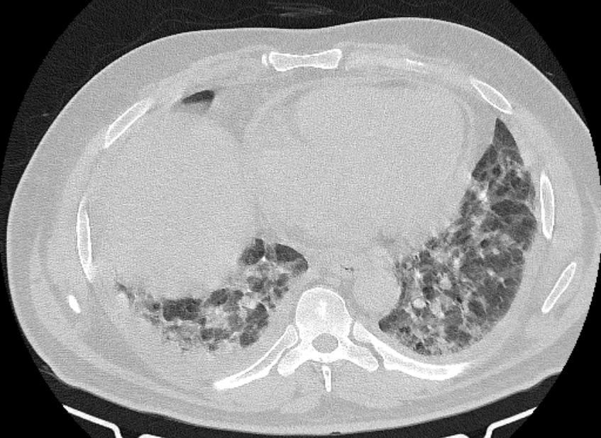 Cardiogenic pulmonary edema (Radiopaedia 68180-77678 Axial lung window 69).jpg