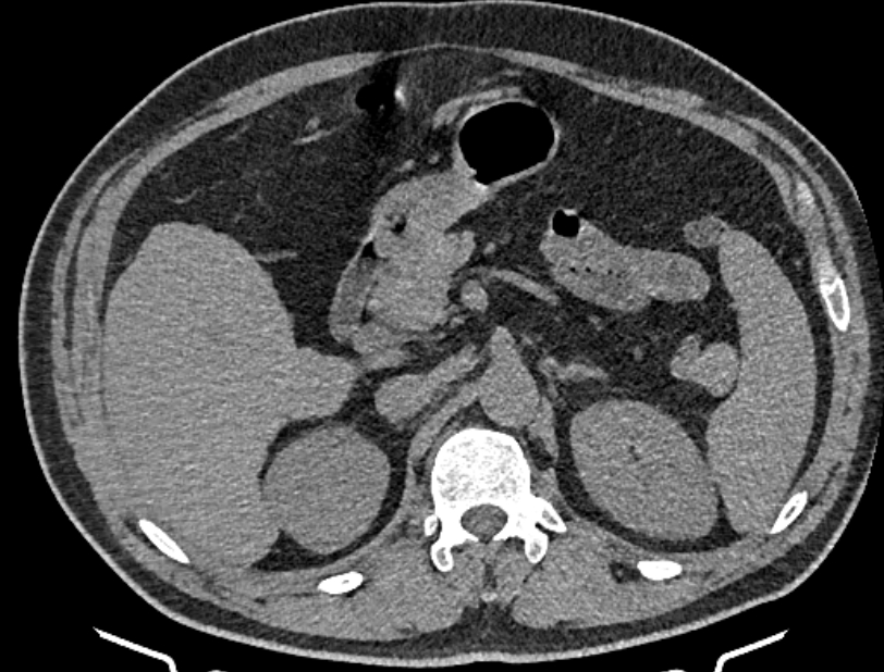 Cardiogenic pulmonary edema (Radiopaedia 68180-77678 Axial non-contrast 69).jpg
