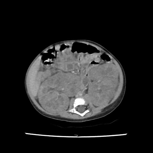 Caroli disease with autosomal recessive polycystic kidney disease (ARPKD) (Radiopaedia 89651-106703 B 127).jpg