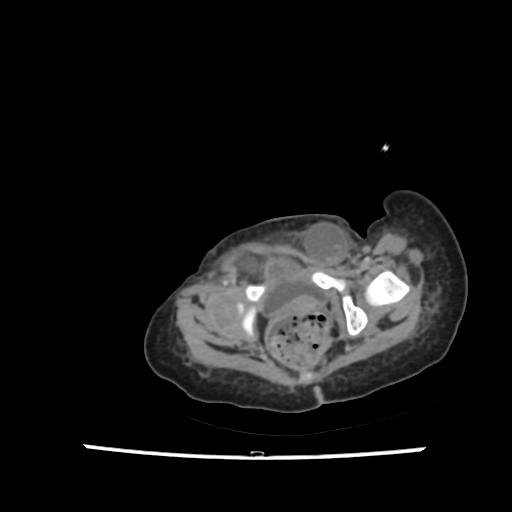 File:Caroli disease with autosomal recessive polycystic kidney disease (ARPKD) (Radiopaedia 89651-106703 B 219).jpg