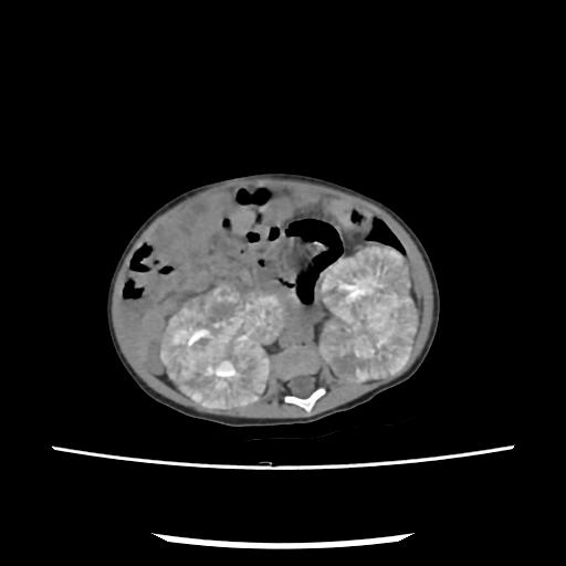 Caroli disease with autosomal recessive polycystic kidney disease (ARPKD) (Radiopaedia 89651-106703 E 120).jpg