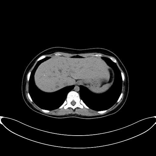 Caroli disease with medullary sponge kidney (Radiopaedia 82622-96804 Axial non-contrast 15).jpg