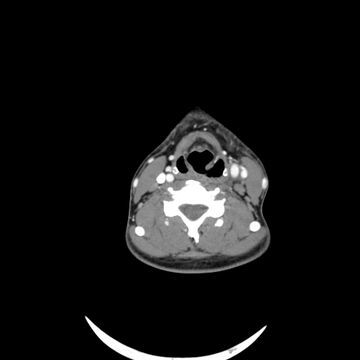 Carotid bulb pseudoaneurysm (Radiopaedia 57670-64616 A 42).jpg
