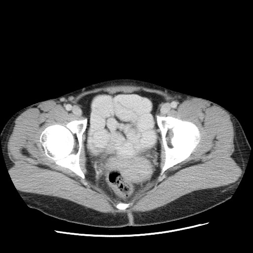 Castleman disease with fibrous pseudotumor in the abdomen (Radiopaedia 77296-89373 A 119).jpg