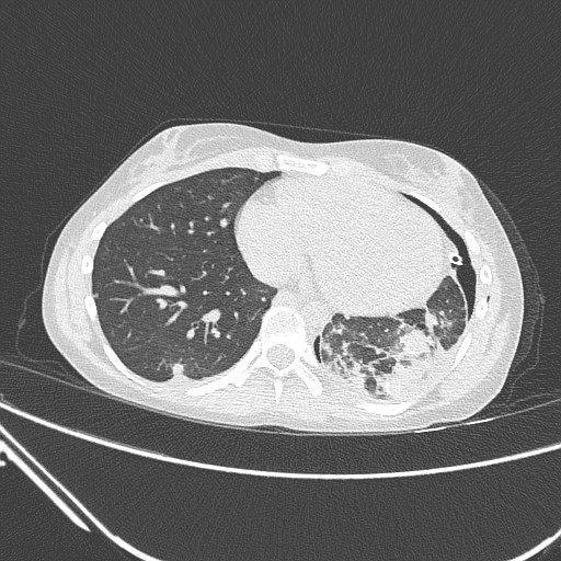 Catamenial pneumothorax (Radiopaedia 27946-28197 lung window 110).jpg