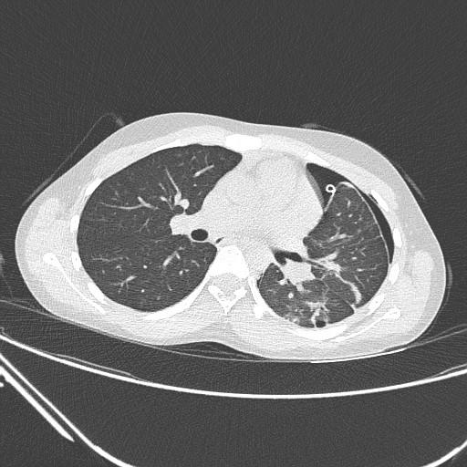 Catamenial pneumothorax (Radiopaedia 27946-28197 lung window 76).jpg