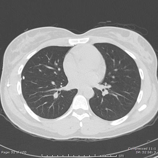 Catamenial pneumothorax (Radiopaedia 54382-60600 Axial non-contrast 52).jpg