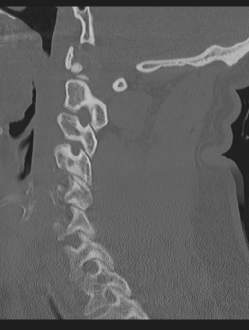 Cavernoma of cervical cord (Radiopaedia 50838-56346 Sagittal bone window 33).png