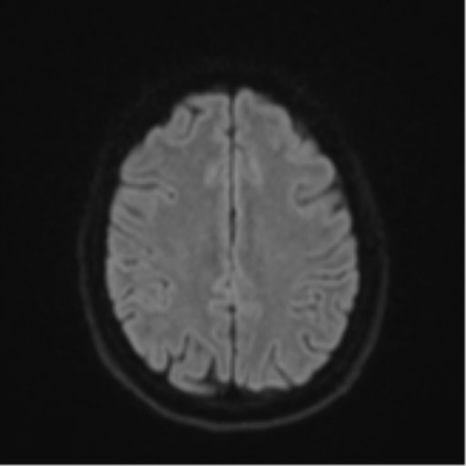 File:Cavernoma with bleed - midbrain (Radiopaedia 54546-60774 Axial DWI 47).png