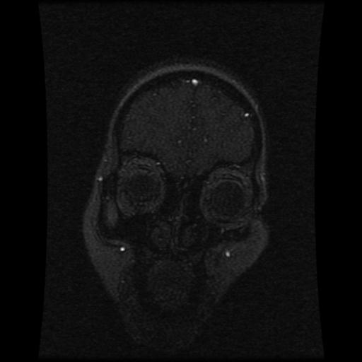 Cavernoma with developmental venous anomaly (Radiopaedia 22470-22507 MRV 108).jpg