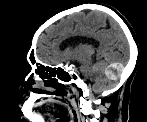 Cavernous hemangioma of the cerebellar falx (Radiopaedia 73025-83723 B 186).jpg