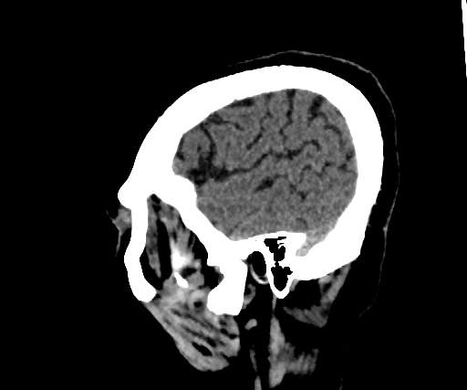 Cavernous hemangioma of the cerebellar falx (Radiopaedia 73025-83723 B 276).jpg