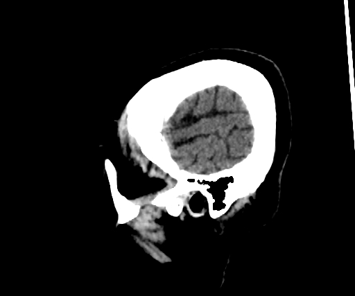 Cavernous hemangioma of the cerebellar falx (Radiopaedia 73025-83723 B 292).jpg