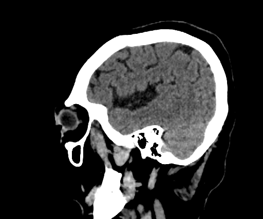 Cavernous hemangioma of the cerebellar falx (Radiopaedia 73025-83723 B 72).jpg