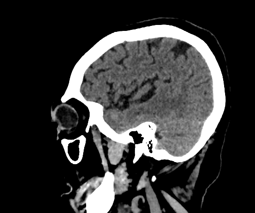 Cavernous hemangioma of the cerebellar falx (Radiopaedia 73025-83723 B 79).jpg