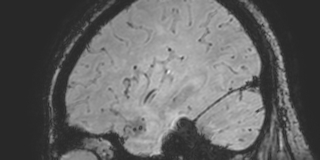 Cavernous hemangioma of the cerebellar falx (Radiopaedia 73025-83724 Sagittal BOLD 159).jpg